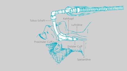 Larynxtubus